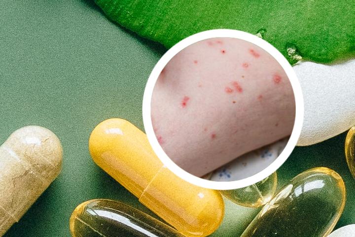 我用偏方治好了银屑病