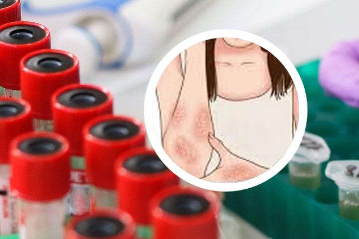 江津哪里看银屑病