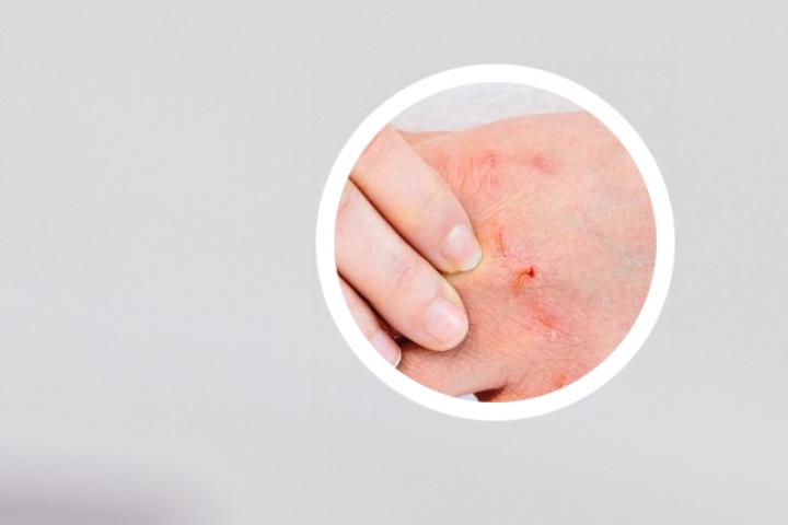 牛皮癣什么症状不能吃韭菜
