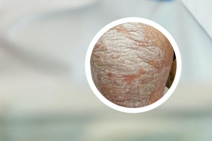 银屑病白斑还用抹药吗