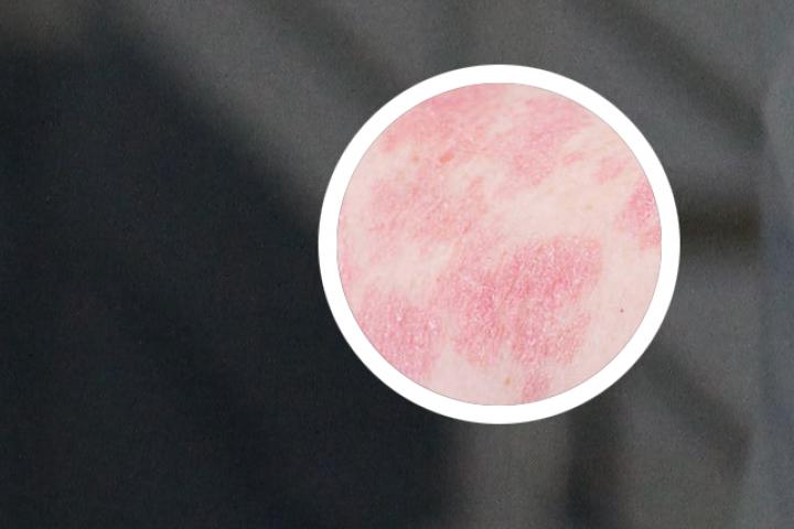 德国的银屑病治疗技术是否先进