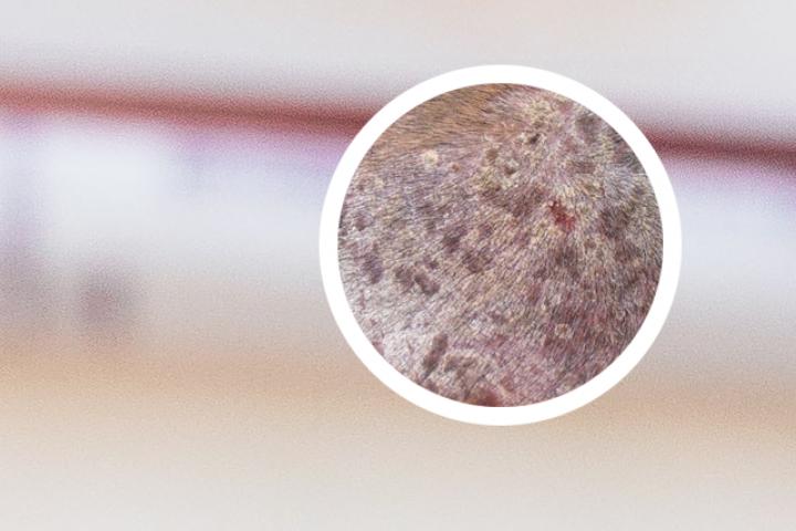 阿维a胶囊治疗银屑病多久见效