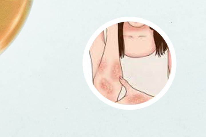 山东得牛皮癣多吗