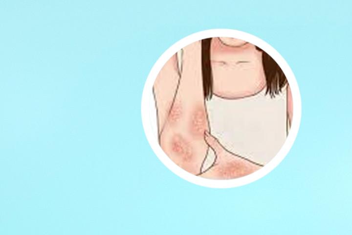 唯一能治好的银屑病