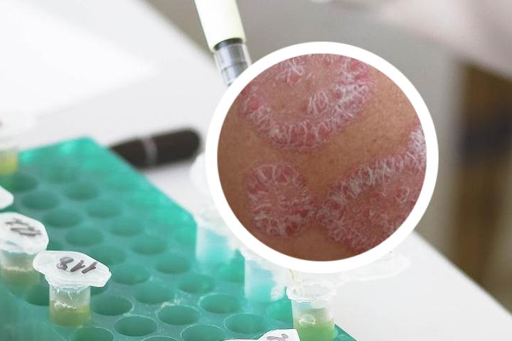 我国批准的银屑病生物制剂