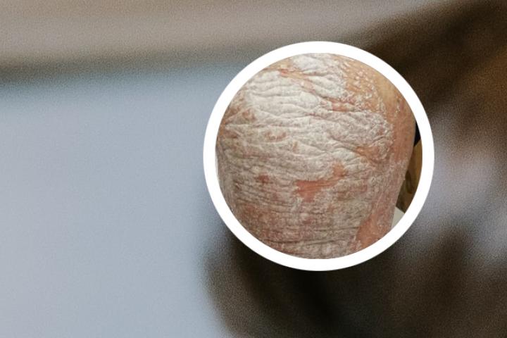 治银屑病的药水叫啥