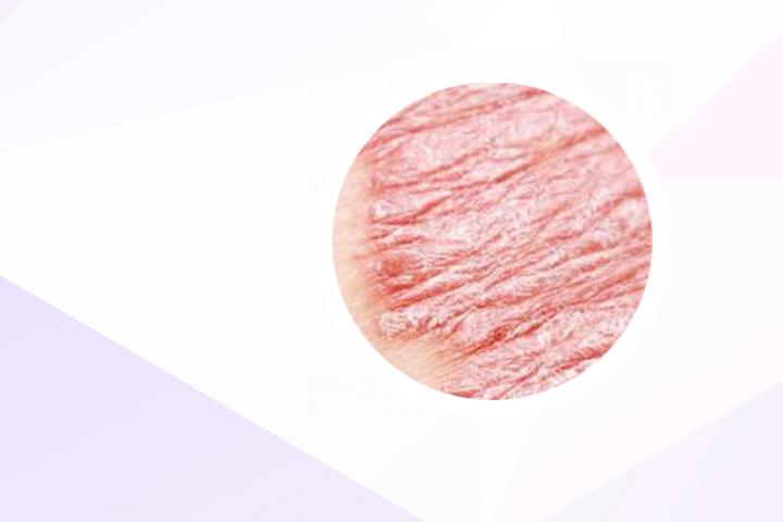 银屑病患者能否纹身