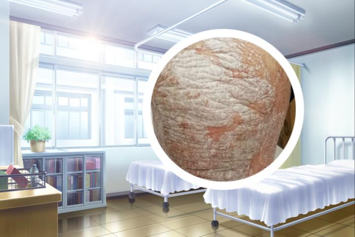 全球银屑病最新进展