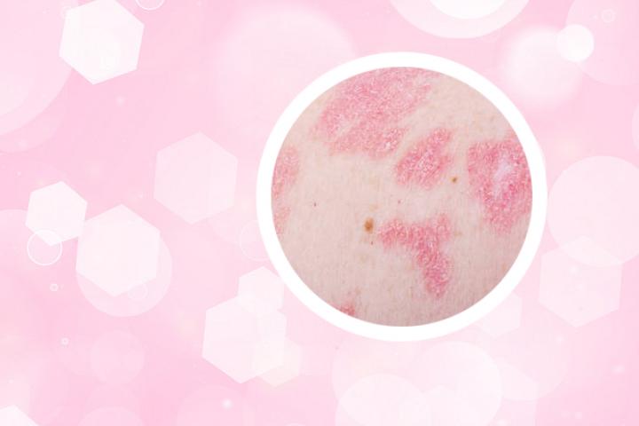 牛皮癣用大蒜怎么治疗