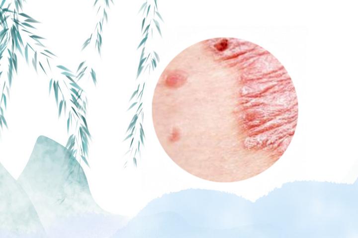 银屑病医院哪个比较好