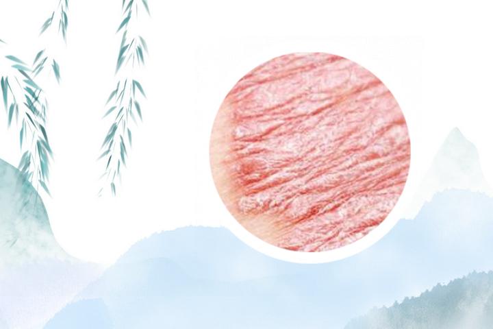 怎样检测银屑病基因