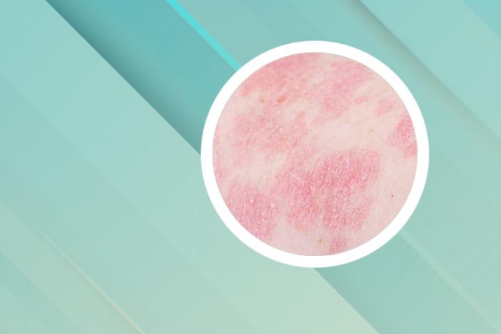 宝宝银屑病