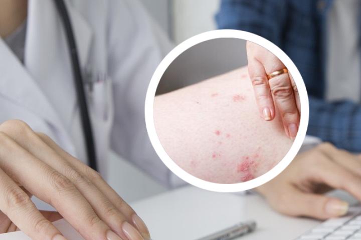 艾草熬水洗治疗银屑病案例