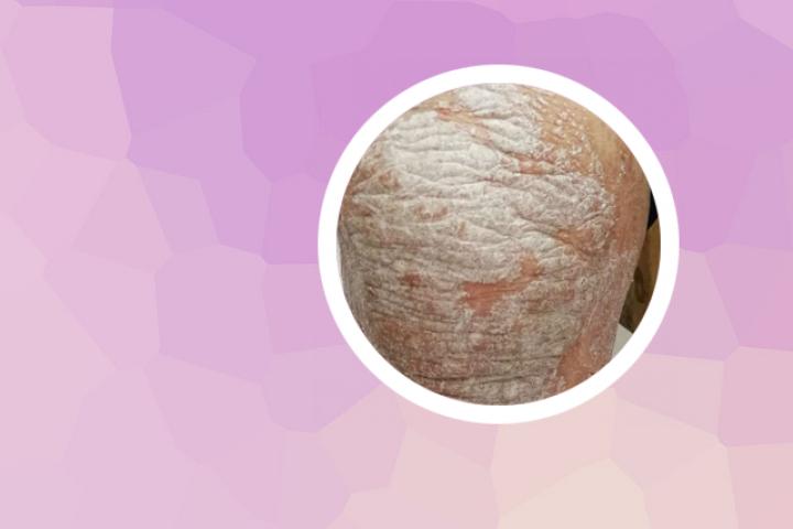 银屑病有救了