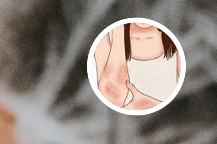 银屑病不能用什么肥皂洗头