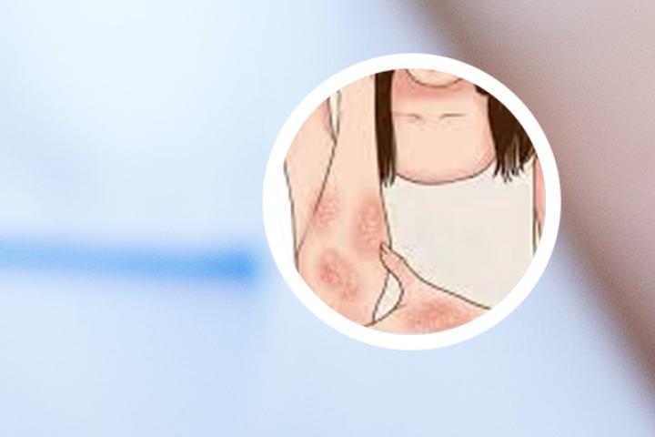 阿达木单抗治疗银屑病用法