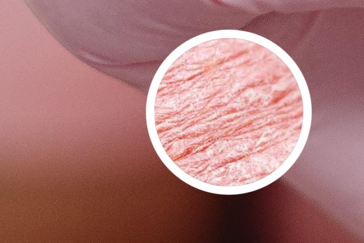 患了银屑病可怕吗