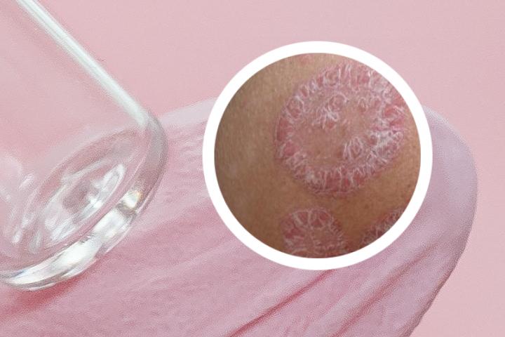 银屑病可以用艾草洗吗