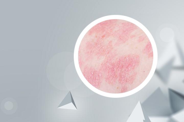 倪海厦牛皮癣怎么治
