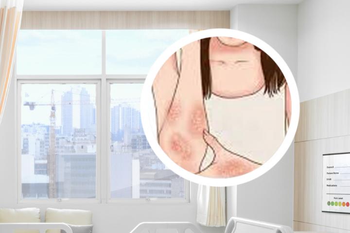 治疗银屑病靶向药