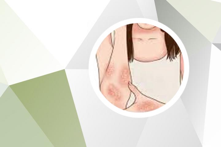 银屑病的纹身可以永久去除吗