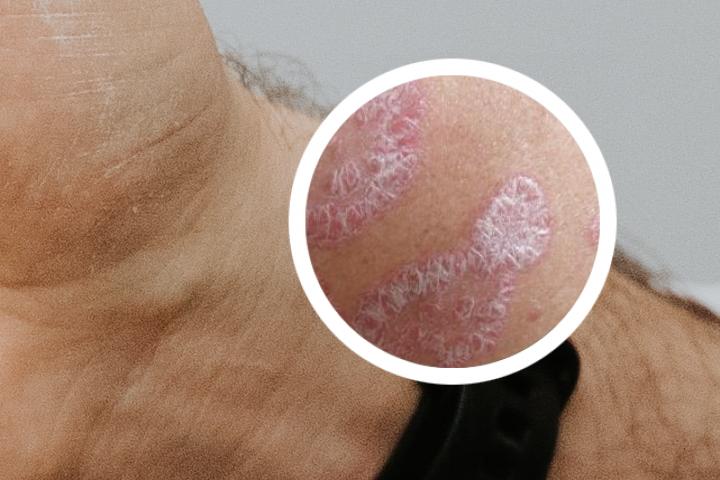 银屑病红色变淡了