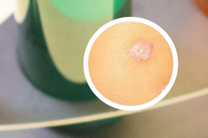 绿豆能治牛皮癣偏方