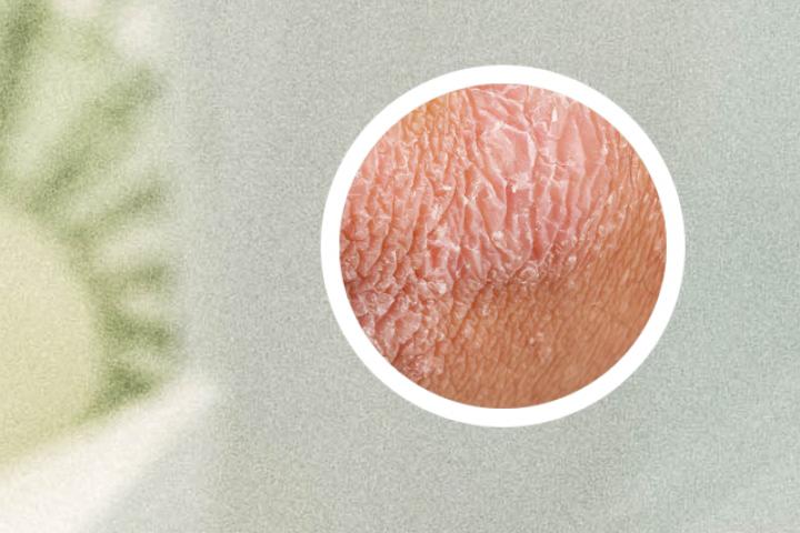银屑病吃药中间还长丘疹
