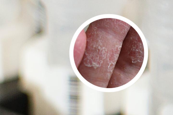 银屑病用碱水能擦洗吗