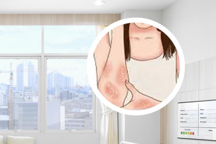 女人什么会引起银屑病