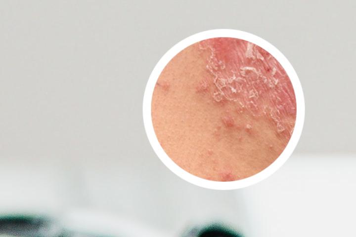 艾草熬水洗治疗银屑病案例