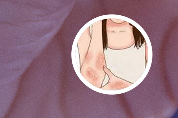 牛皮癣吃多维元素