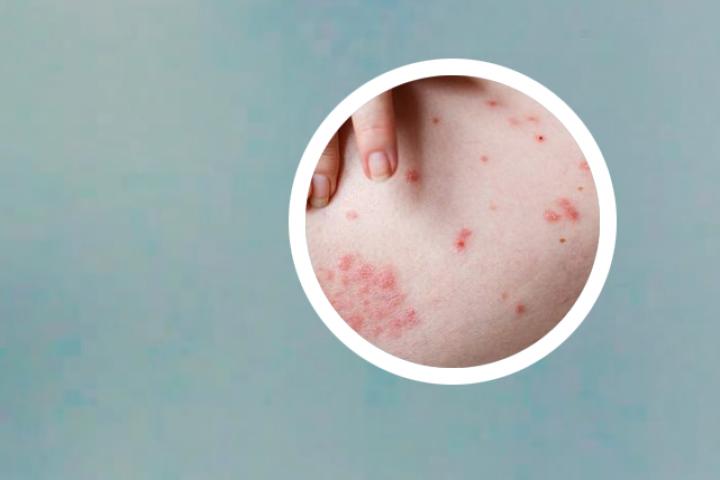 治疗头皮银屑病药水