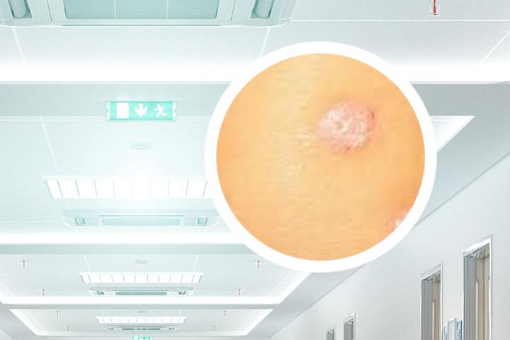 银屑病可以打HPV