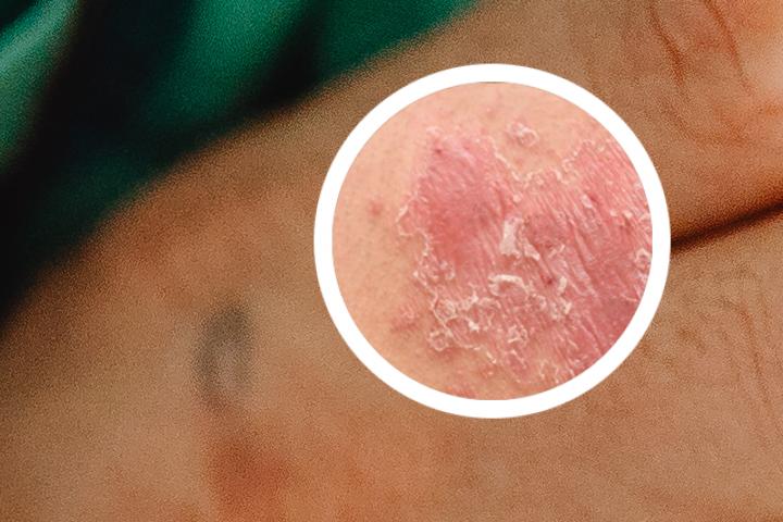 男士牛皮癣的遗传概率