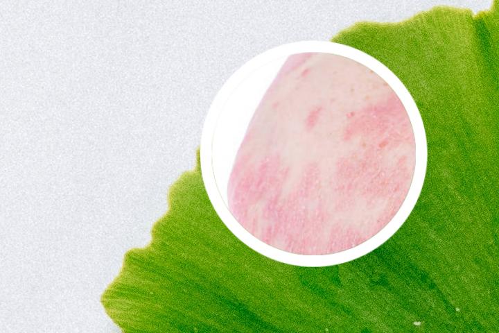 牛皮癣能喝红豆薏米水吗