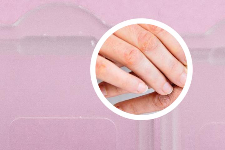 银屑病可以用什么中药泡澡