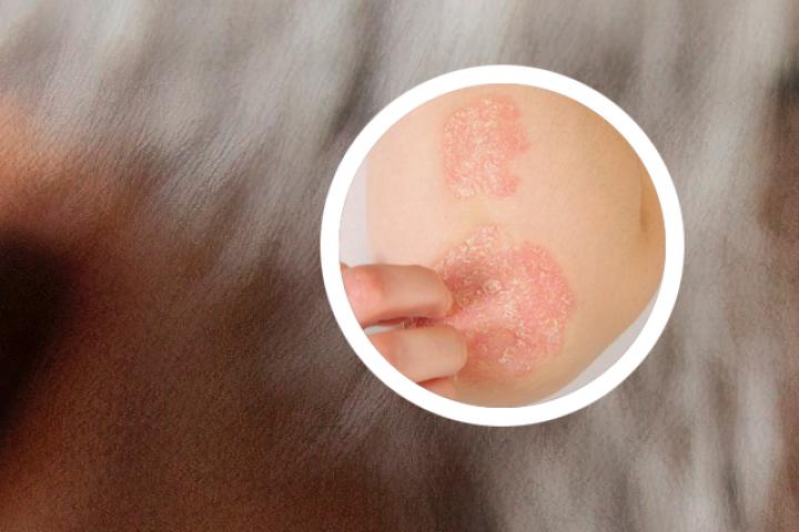 银屑病和疥虫谁严重