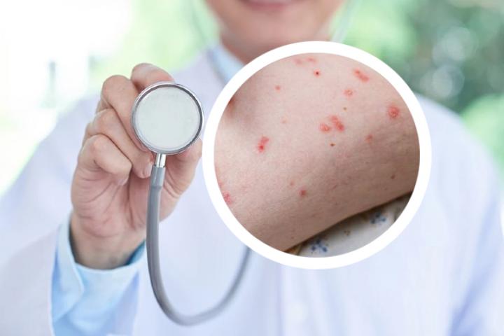 银银屑病关节炎泳治疗