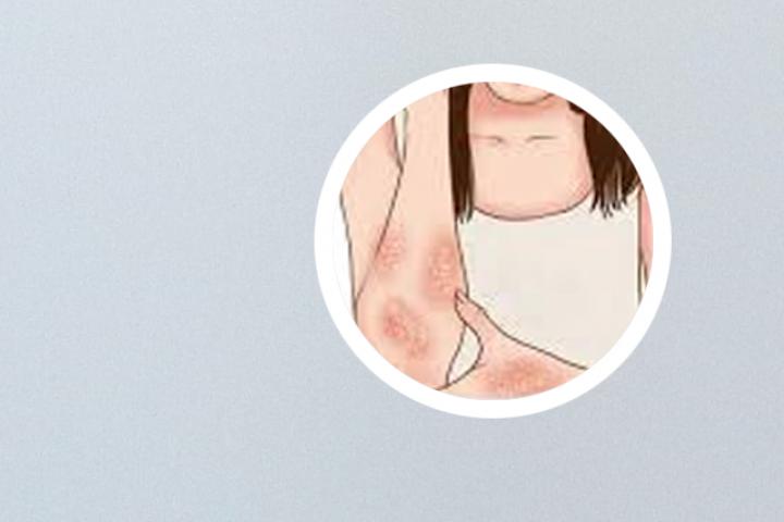 花椒红糖水能治疗牛皮癣吗