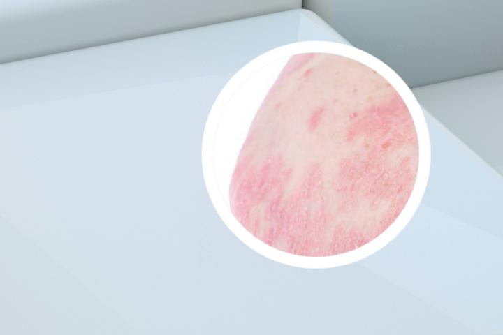 白斑病银屑病同时 银屑病好了之后的白斑