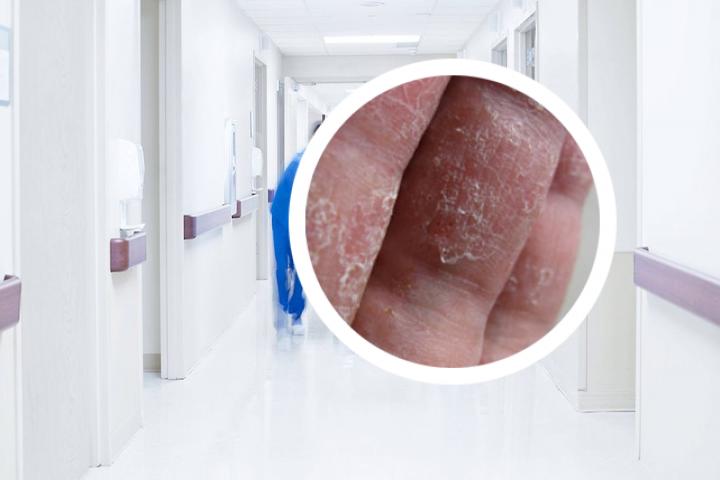 治疗银屑病用什么生物制剂