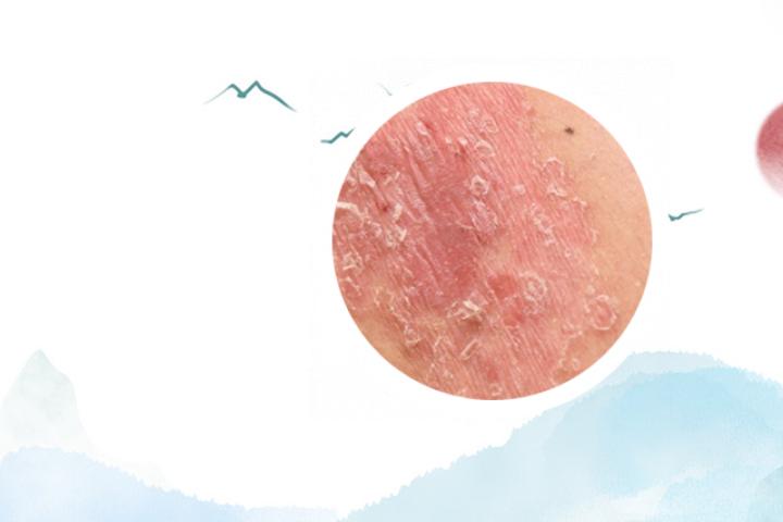 银屑病是隐性遗传还是显性