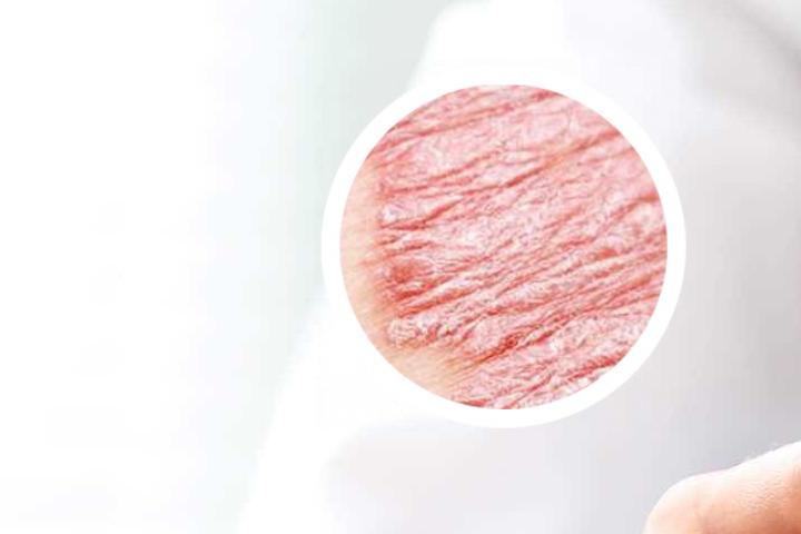 牙膏对牛皮癣有用不