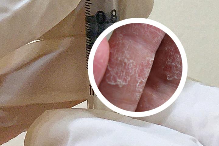 女性银屑病