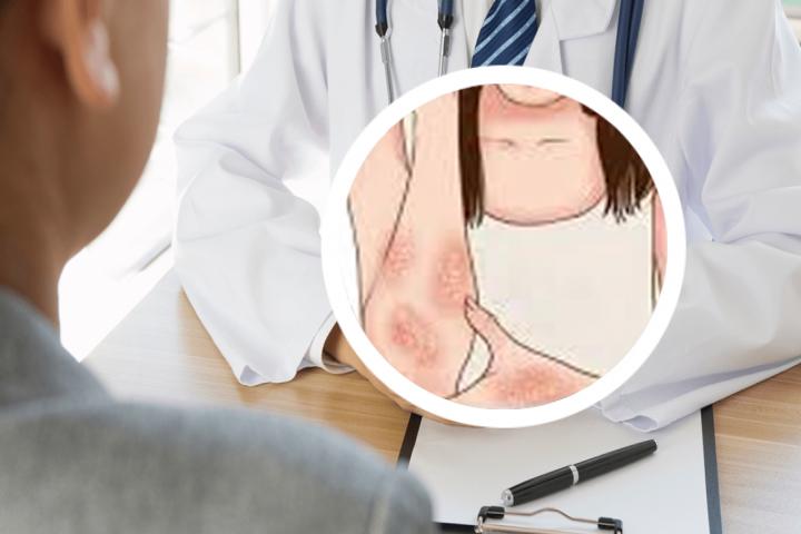 艾洛松治的好寻常型银屑病吗