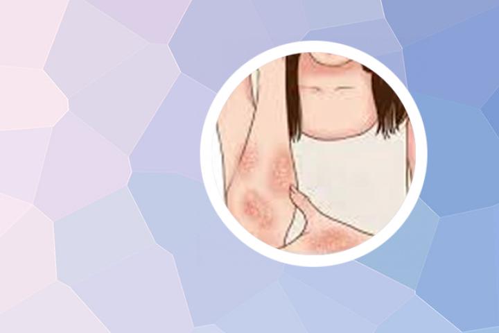 患了银屑病可怕吗