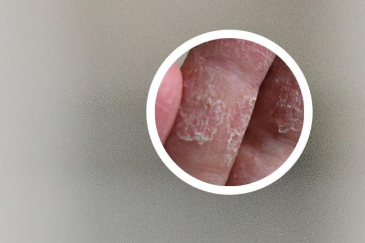 银屑病必须都长出来