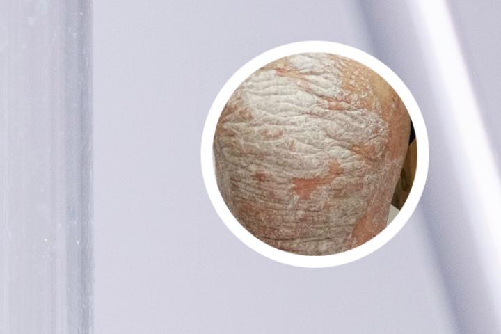 艾洛松治疗银屑病用法