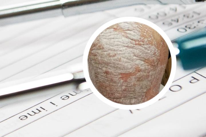 局限性脓疱型银屑病